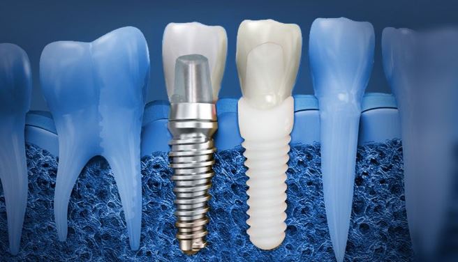 dental implant.JPG